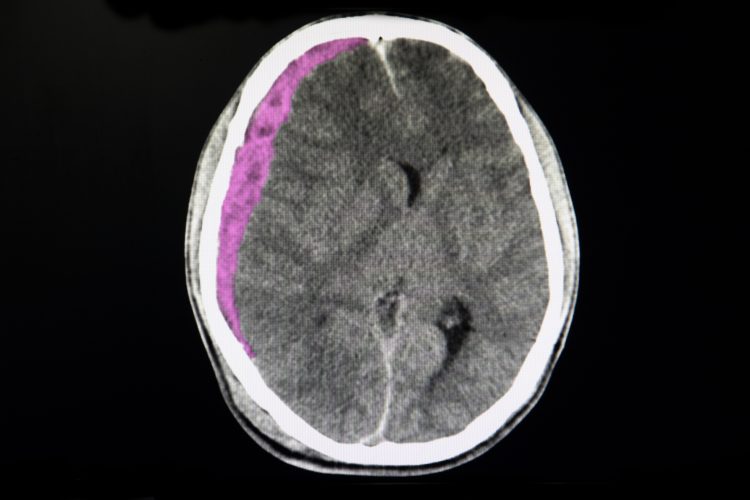 Bild på hjärnskada.