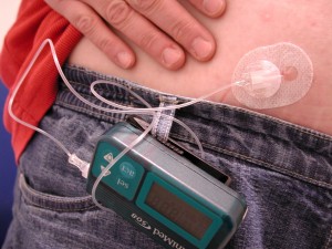 Dags att införa tidigare diagnos och behandling av typ 1-diabetes