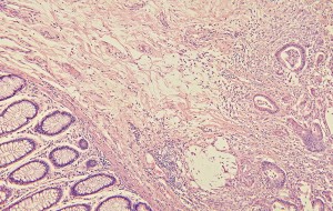 Nya möjligheter att oskadliggöra cancertumörer