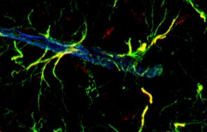 Blodkärl påverkas av behandling vid Parkinsons sjukdom