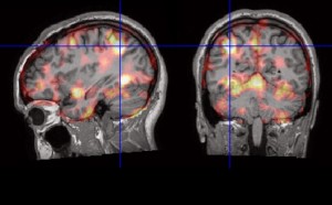 Patienter med svår epilepsi undersöks med unik metod