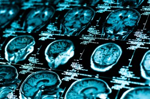 Ny mekanism för att reparera hjärnan efter stroke