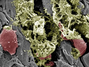 Falsklarm från kroppen kan ligga bakom akut bukspottkörtelinflammation