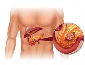 Nytt test för att tidigt upptäcka bukspottkörtelcancer