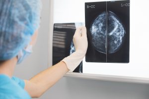 AI-modell med stor potential att minska kirurgi i armhålan vid bröstcancer