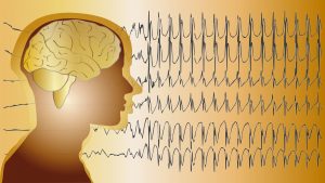 Knutor på hjärnan triggar epileptiska anfall – kan kirurgi hjälpa?