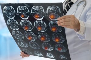 Vad kan man göra för att förebygga stroke?