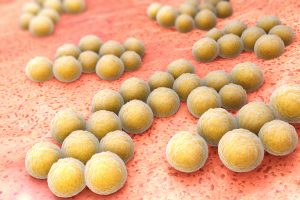 Sepsis – ett livshotande tillstånd