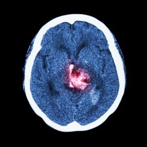 bilden visar ett skiktröntgen snitt av hjärnan som visas i blått. Hjärnans ses uppifrån och mitt på hjässan syns ett rosa område som visar att där sker en blödning