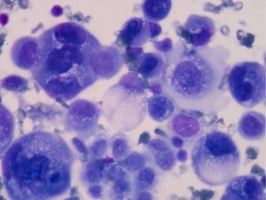 Lungcancer: snabb diagnosticering ger bättre målinriktad behandling