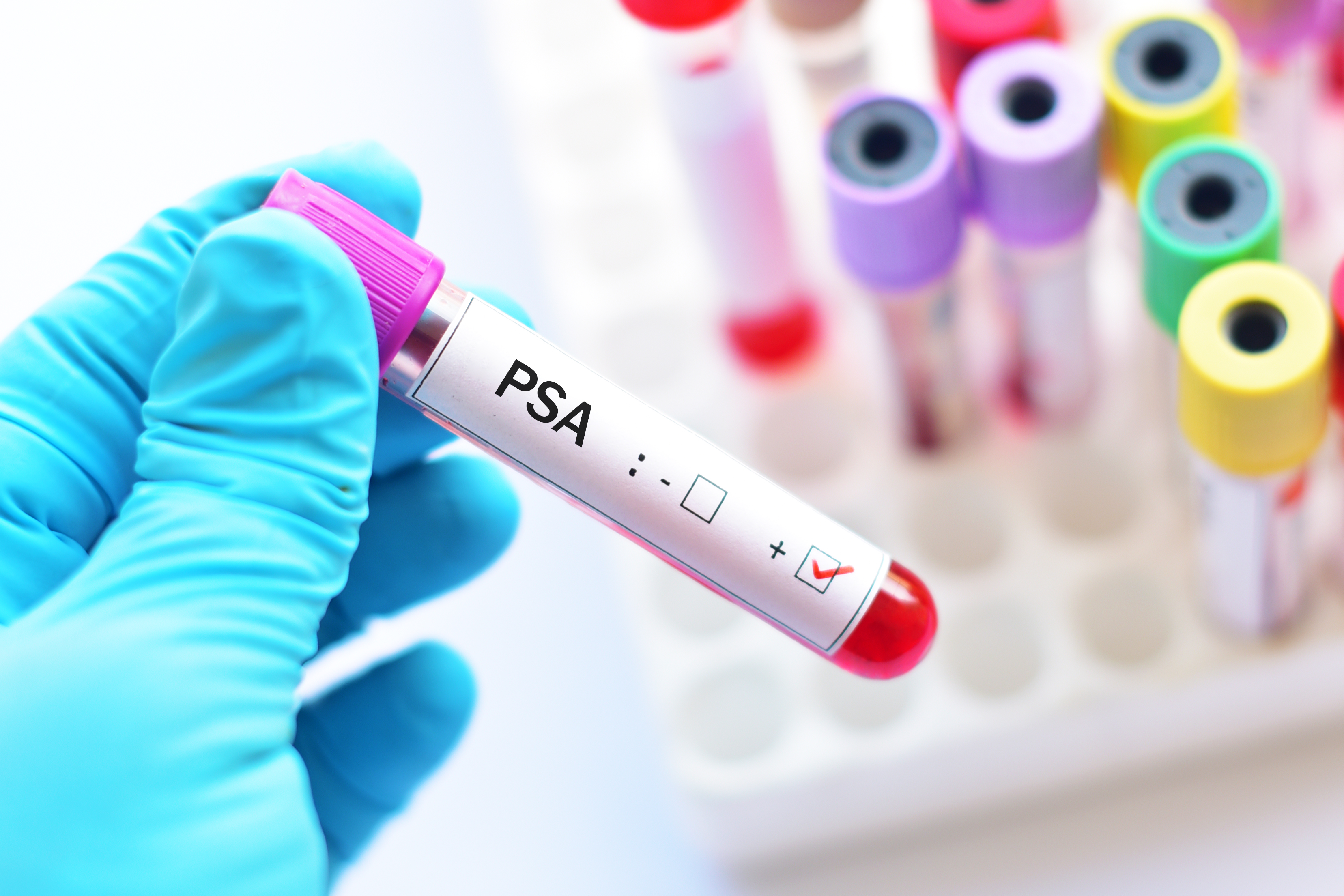 cáncer de próstata metástasis pulmonar tratamentul prostatitei semashko