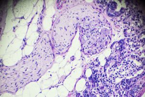 Snabbare och säkrare diagnoser med artificiell intelligens