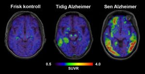 Studie ger bild av alzheimer långt före utvecklad sjukdom