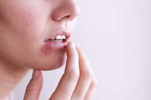 Ny metod kan stoppa herpesvirus