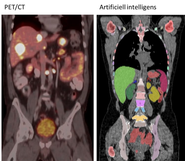 Bilden är en sammansättning av två bilder. Den vänstra visar en kombinerad PET/CT-undersökning med tumörer som lyser i levern. Den högra visar hur den artificiella intelligensen lärt sig rita ut olika organ och skelett inuti kroppen.