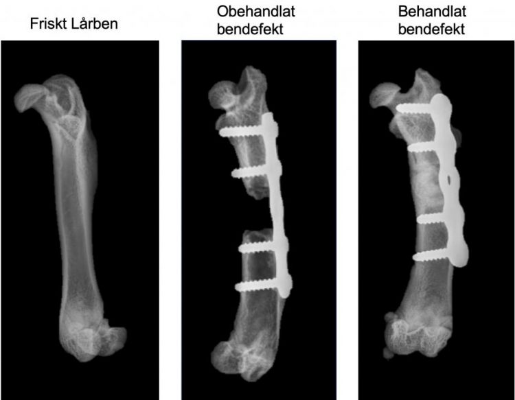 på bilden ses tre röntgenbilder. I den vänstra ses ett frisk lårben helt utan frakturer. Mittenbilden visar en obehandlad bendeffekt där man ser hur det brutna lårbenet, som inte har växt ihop, stabiliseras av en skena. Bilden till höger visar ett behandlat lårben där brottet har växt ihop