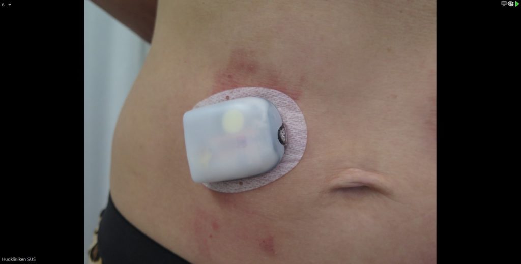 bilden visar en bar magen med en liten vit dosa fastsatt med någon form av plåster strax till höger om personens navel. På bilden ser man tydligt att huden runt insulinpumpen är irriterad och rödflammig.