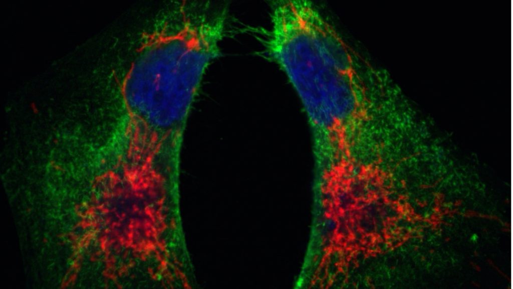 Bilden är en mikroskopibild av bröstcancerceller där olika typer av celler är färglagda och ses som sammanhängande fält av rött, grönt eller blått. 