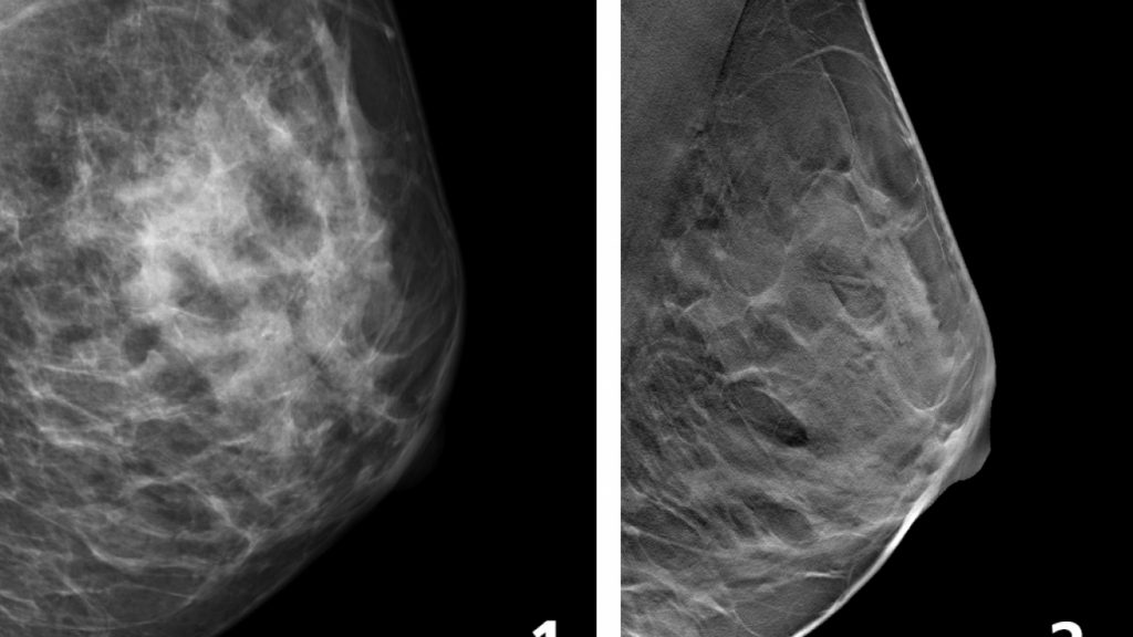 På bilden ses två röntgenbilder av bröst, båda brösten ses från sidan. Den väsntra bilden är tagen med vanlig mammografi, visar färre detaljer än den högra som ä tagen med 3D-teknik