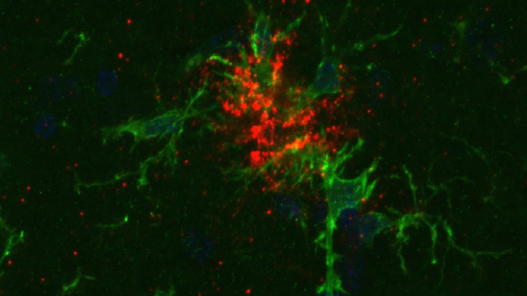 Bilden är en mikroskopibild av mikrogliaceller och beta-amyloid. För en lekman ser det ut som röda klumpar som omges av mer trådliknande gröna strukturer. Hur detta ska uttolkas framgår av bildtexten