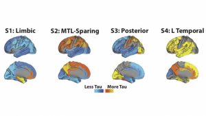 Alzheimers sjukdom – fyra distinkta subtyper