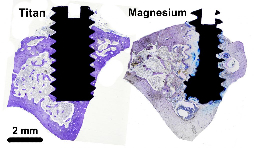 Bilden, som är tagen i ljus-mikroskop, visar skruvar av olika material i ben, två månader efter insättning. Till vänster ses en titanskruv, till höger en magnesiumskruv. Metallen (både titan och magnesium) är svart i bilden, medan benet färgas i lila. Magnesiumskruven har börjat lösas upp och omvandlas till ett benliknande ämne. Foto: Silvia Galli