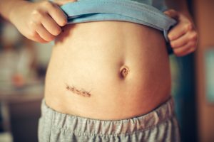 Samband mellan stress och blindtarmsinflammation