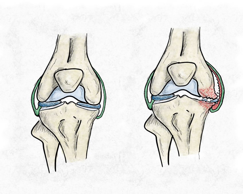 en tecknad illustration av en frisk och en artrosdrabba knäled