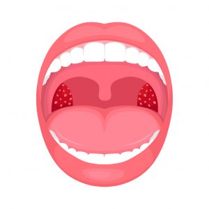 illustration av mun med tonsiller, dvs. halsmandlar markerade