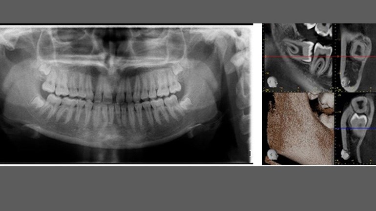 olika röntgenbilder av tänder