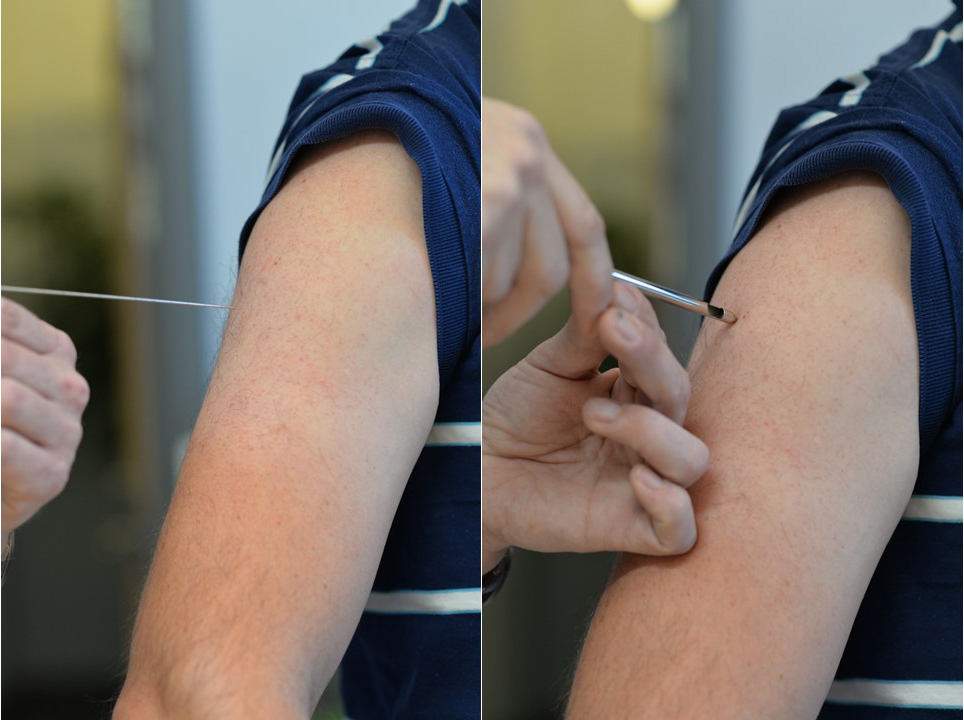 bild på två olika tjocks biopsinålar riktade mot en överarm