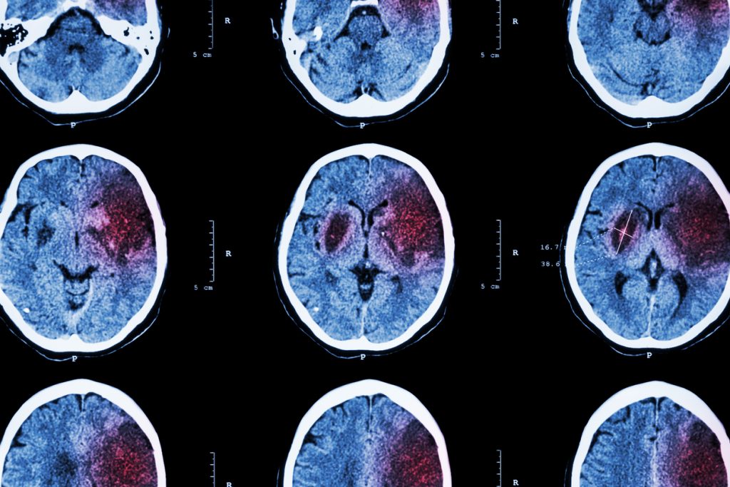Röntgenbild av strokedrabbad hjärna