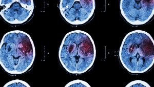 Föreläsning: Stroke mitt i livet