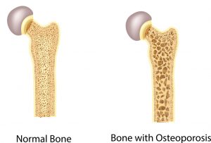 Material som bildar ny benvävnad vid osteoporos