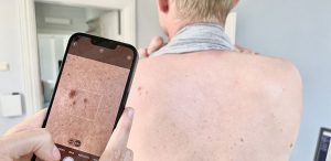 Hudcancer-appar brister i information och märkning