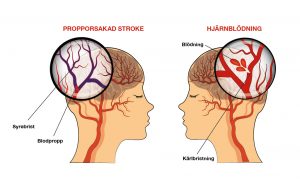 Stroke – olika för kvinnor och män