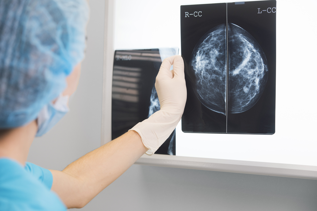 AI-stöd vid bröstcancerscreening: Färre missade cancerfall