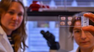 Hjärnväg bakom impulsivitet vid Parkinsonsbehandling upptäckt