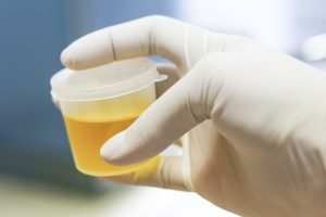 Urinprov kan bedöma återfall av njurcancer