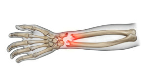 “Bra nog” inte tillräcklig bra vid behandling av handledsfrakturer