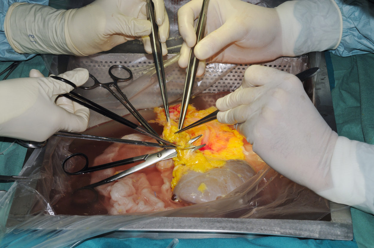 De första kritiska minuterna när ny njure kopplas på