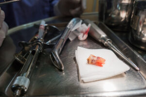 Okej att ta blodförtunnande vid tandborttagning