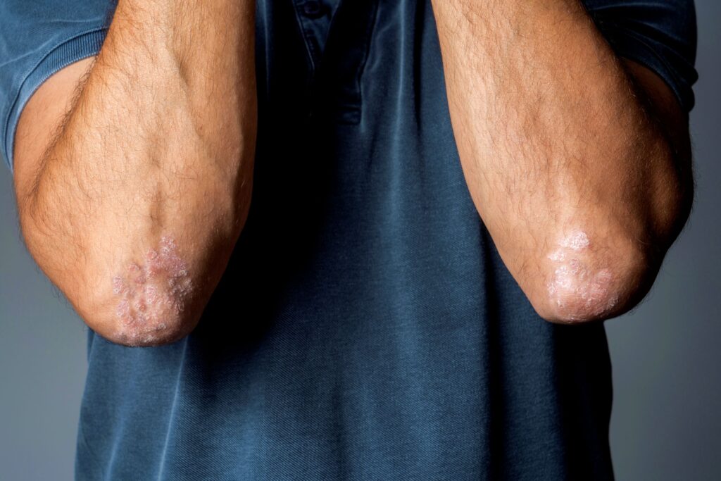 Bild på man som visar sina armbågar som är täckta av fjällande psoriasissår