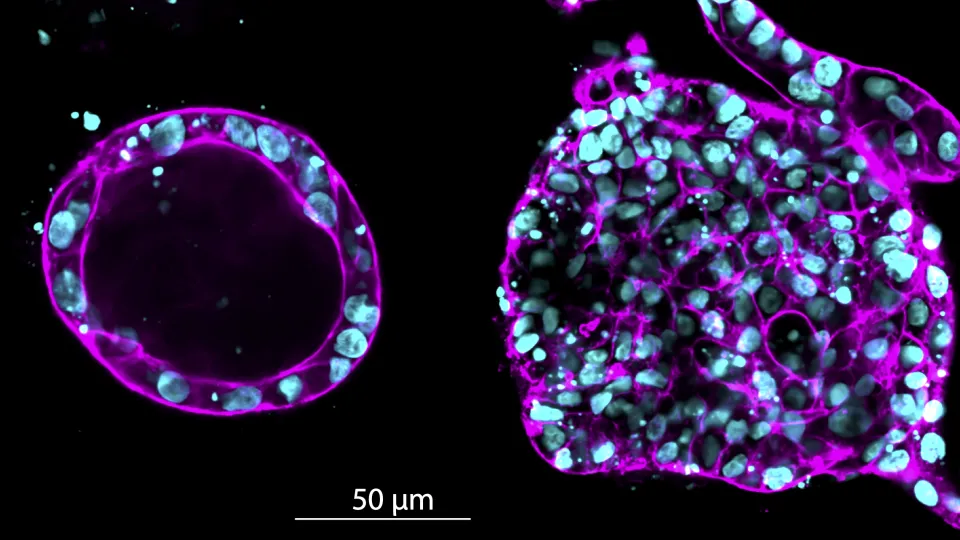 Fluorescensmikroskopisk bild som visar cellkluster från bröstvävnad som odlats dels i en mjuk gel, dels med hård gel.